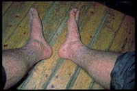 So können Füße nach wenigen Tagen in Lappland aussehen